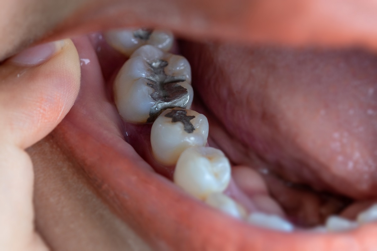 Amalgam Fillings