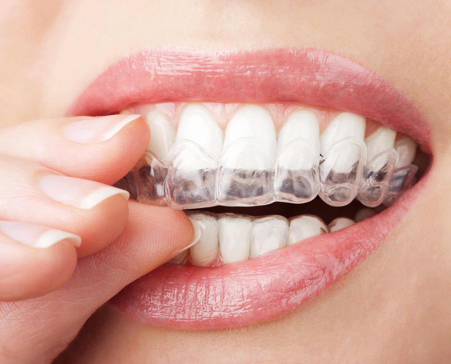 Braces & Invisalign Services