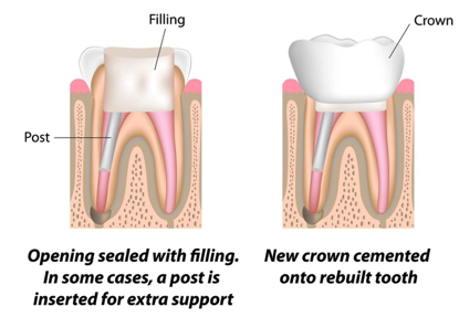 Dental Bonding