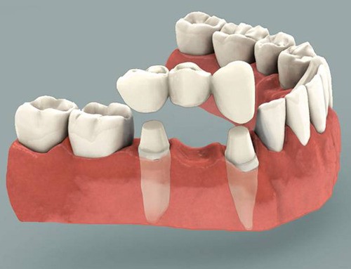 Dental Bridge Services