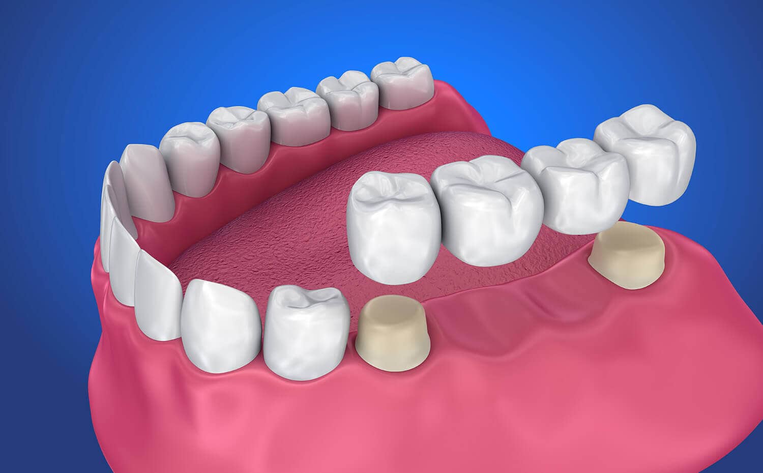 Dental Crown & Bridges