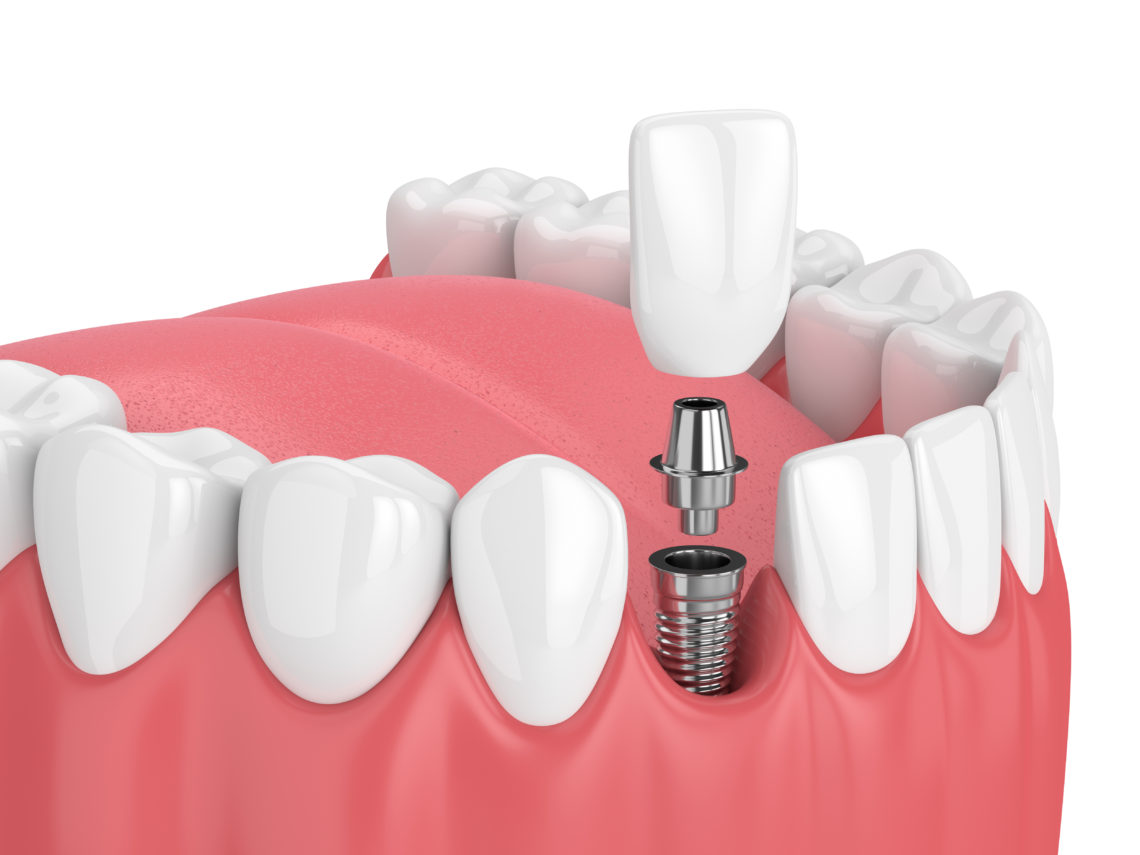 Dental Implants Services