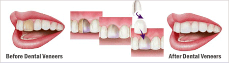 Dental veneer before and after