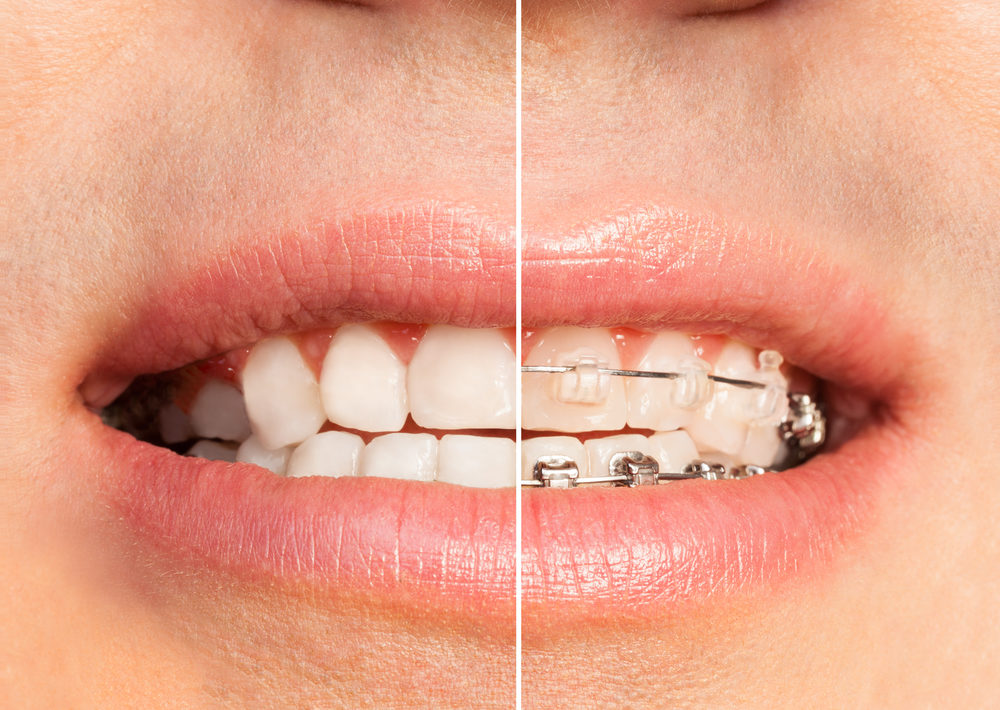 Invisalign Clear Braces Miramar