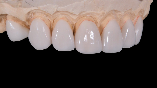 Porcelain Veneers Services