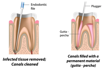 Root Canal